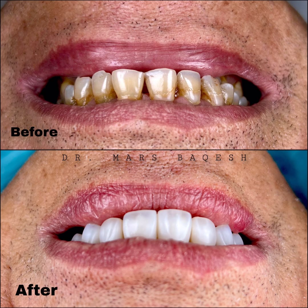 Composite Veneers