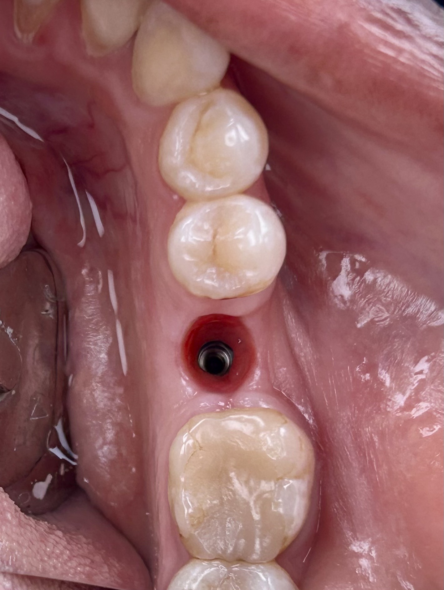 Dental Implants