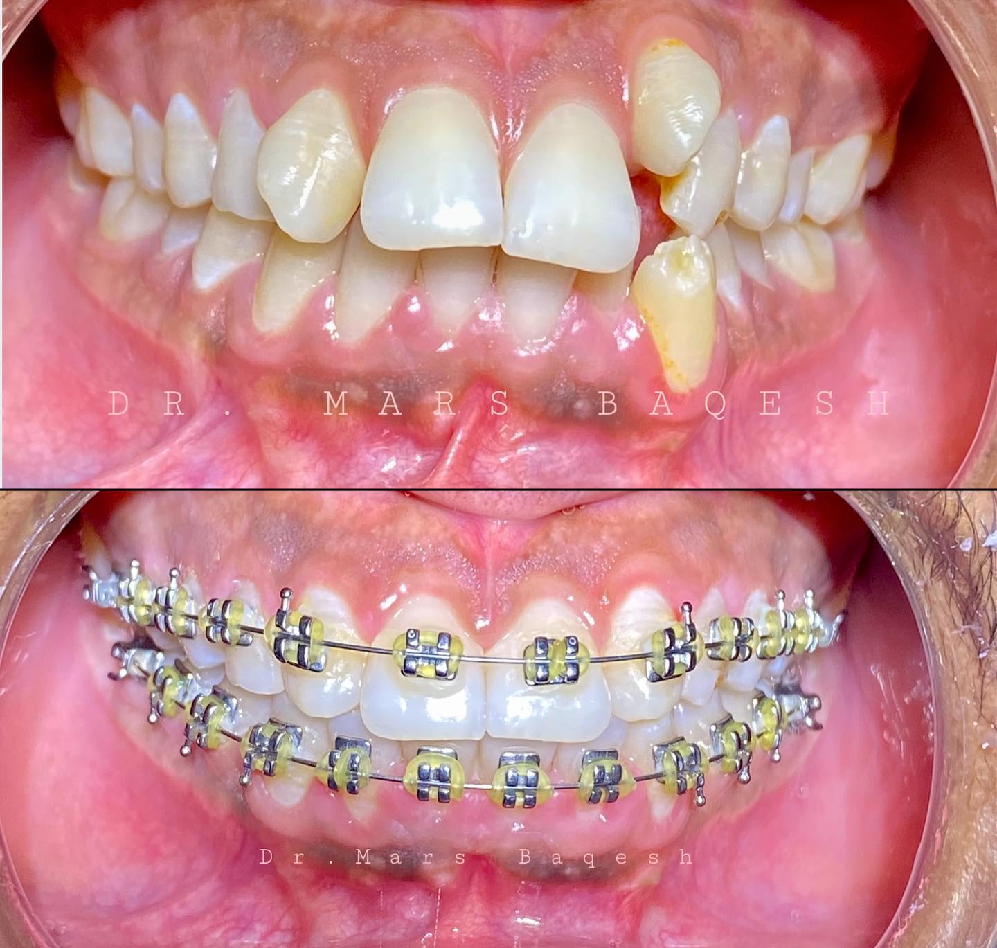 Orthodontic Treatment