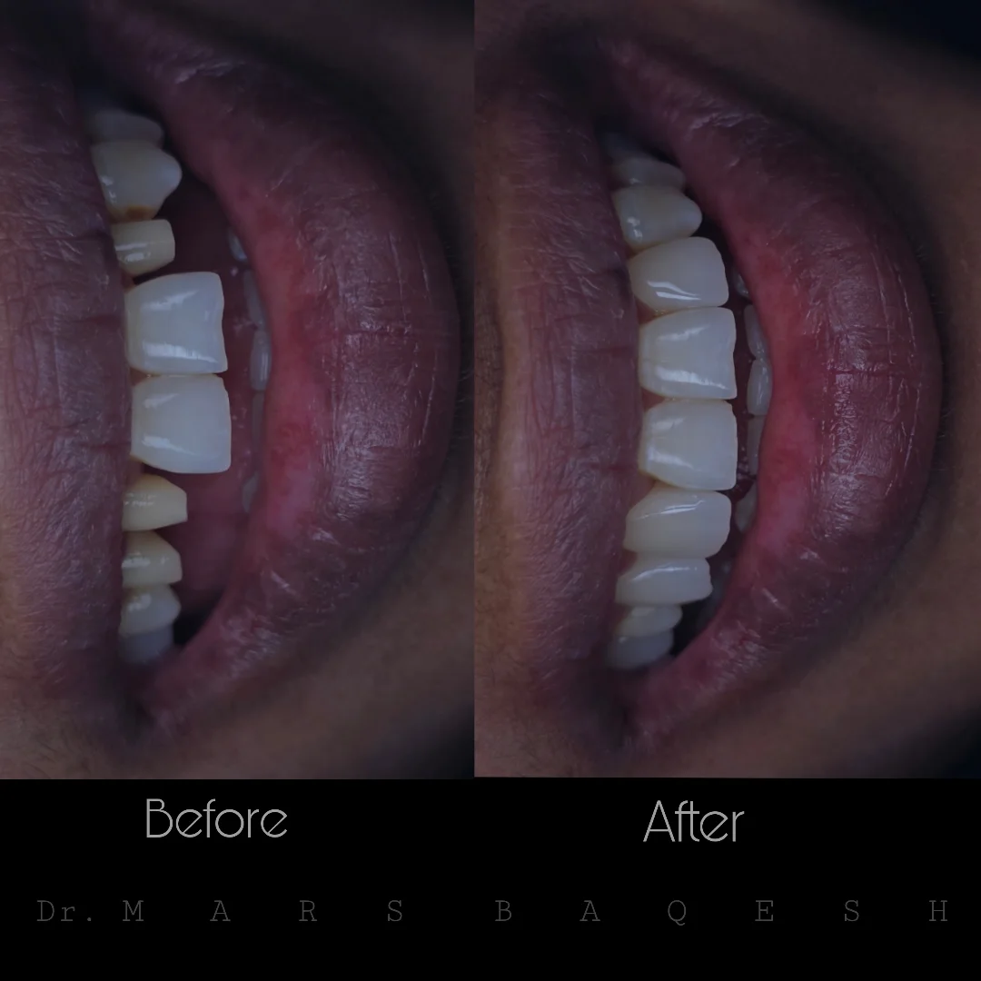 3-Unit Monolithic Solid Zirconia Fixed Bridge fitting. Replacing missing tooth gaps with zero grey metal lines along the gum border. ✨