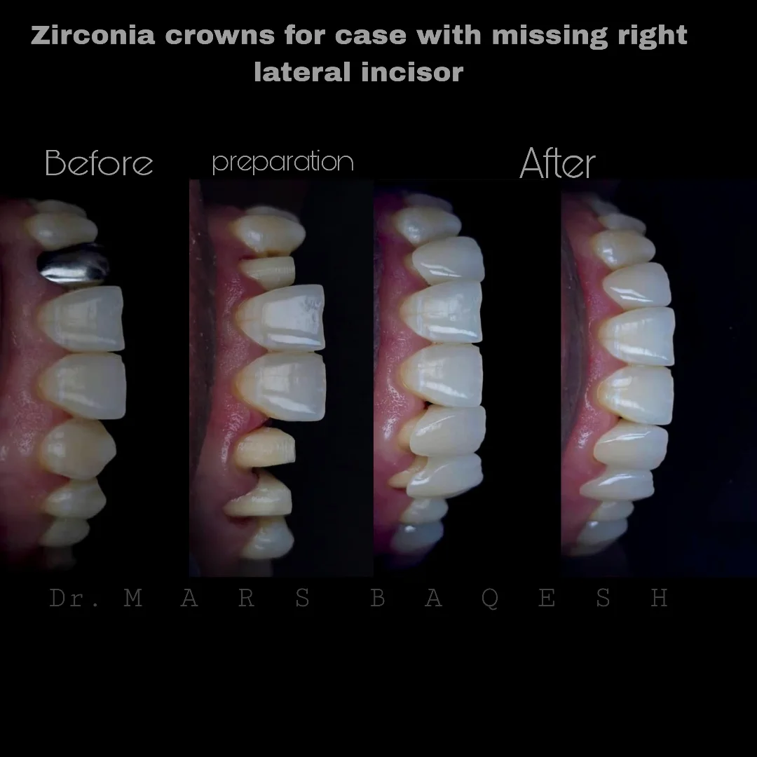 Zirconia Crown